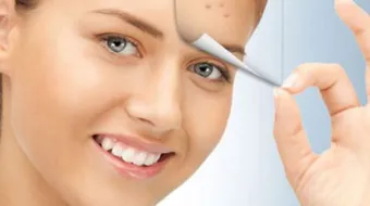 طريقة علاج حب الشباب بسرعة