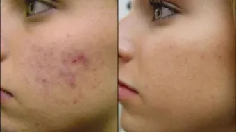 كيف تعالج بقع حب الشباب