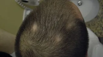 كيفية علاج ثعلبة الشعر