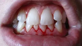 كيف تعالج نزيف اللثة