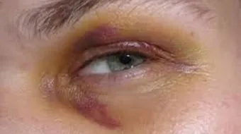 كيفية علاج الرضوض