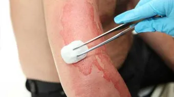 كيف نعالج الحروق من الماء الساخن