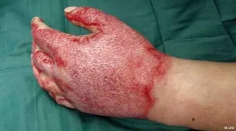 كيف نعالج الحروق