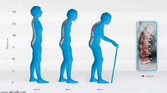 كيفية علاج تقوس الظهر