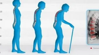 كيفية علاج تقوس العمود الفقري