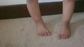 كيفية علاج تقوس الساقين