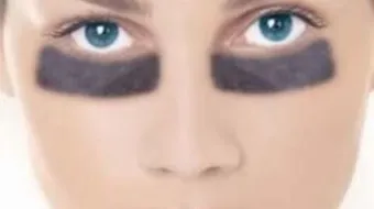 كيف تعالج سواد تحت العين