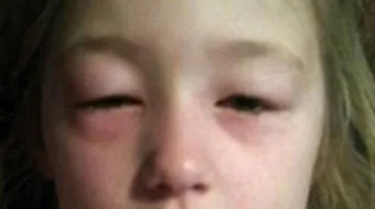 كيفية علاج تورم العين