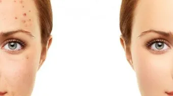 طريقة علاج حبوب الوجه