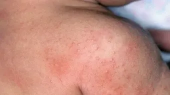 طريقة علاج حمو النيل