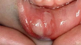 كيفية علاج الفطريات