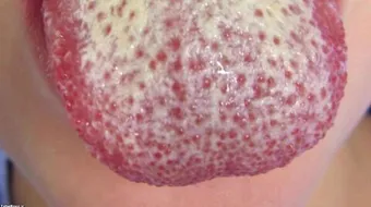 كيفية علاج الفطريات في الفم