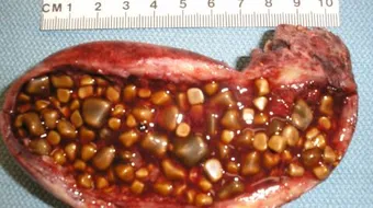 كيفية علاج حصى المرارة