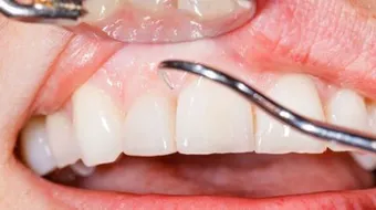 كيف أعالج التهاب اللثة