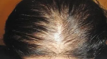 كيف تعالج تساقط الشعر من الأمام