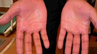 كيفية علاج تعرق اليدين