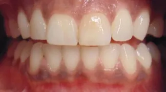 كيف تعالج اللثة الملتهبة