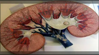 كيف تعالج حصوة الكلى