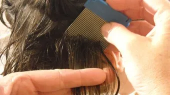 كيفية علاج بيض القمل