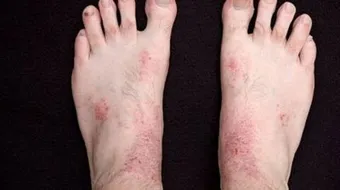 كيفية علاج أكزيما الرجلين