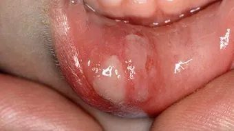 كيف أعالج فطريات الفم