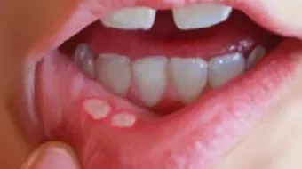 كيف أعالج فطريات الفم عند الأطفال