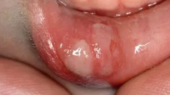 كيفية علاج تقرحات الفم