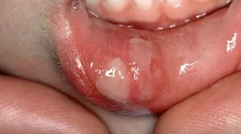 كيف تعالج تقرحات الفم