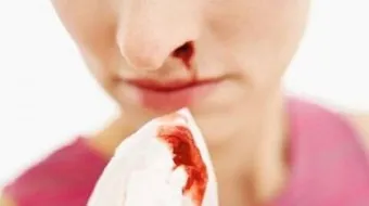 كيفية علاج الرعاف