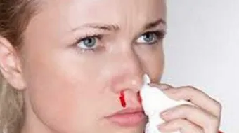 كيف نعالج الرعاف