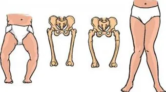 كيفية علاج لين العظام عند الأطفال