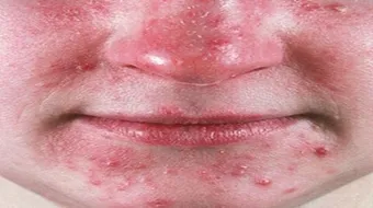 كيف تعالج احمرار الوجه