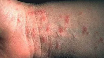 كيفية علاج الجرب