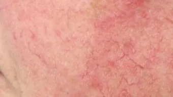 كيف تعالج حساسية الجلد