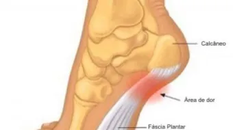 كيفية علاج العظمة الشوكية