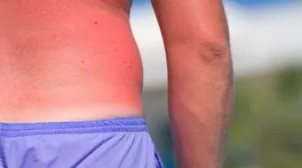 كيف تعالج حروق الشمس