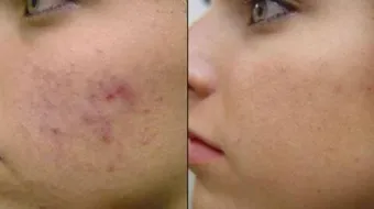 كيفية علاج آثار الحبوب