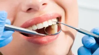 كيف نعالج تسوس الأسنان دون طبيب