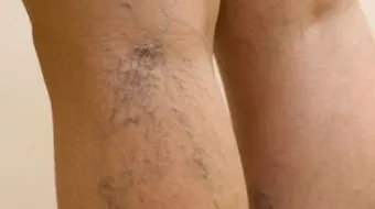 كيف نعالج مرض الدوالي