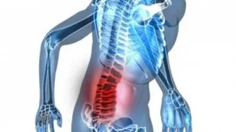 كيفية علاج انزلاق الفقرات