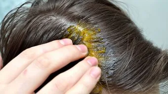 طريقة استخدام الثوم للشعر