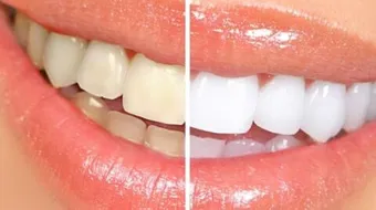 كيفية تبييض الأسنان