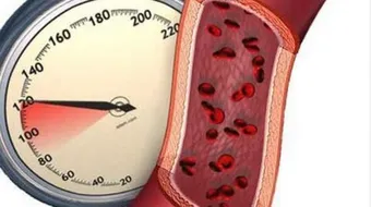 ارتفاع ضغط الدم