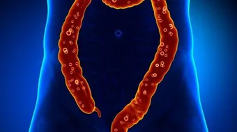 القولون العصبي