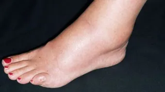 زيادة الماء في الجسم