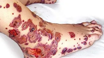 التهاب الدم وأسبابه