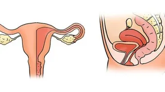 التهاب الرحم