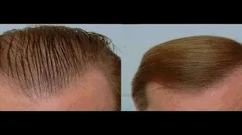 تكثيف الشعر الدهني