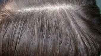 حبوب الحديد للشعر