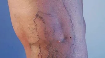 هل الدوالي مرض خطير